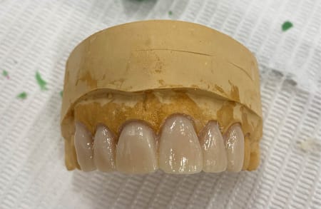 Direct Veneers