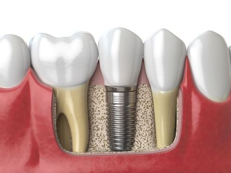 Intermediate Implant Prosthetics - Plan to Succeed