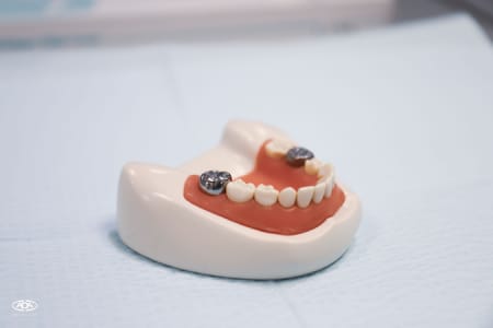 Preserving Primary Teeth: Pulpotomy and Stainless-Steel crown