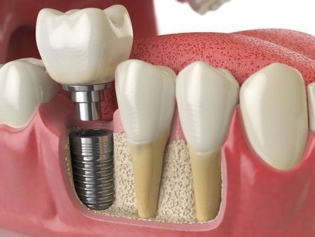 Restoring a Single Implant