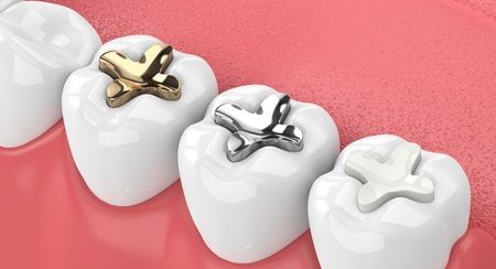 Illustration of a row of teeth with gold and silver amalgam in them