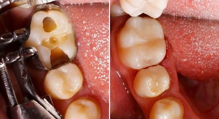Caries in teeth being treated with amalgam