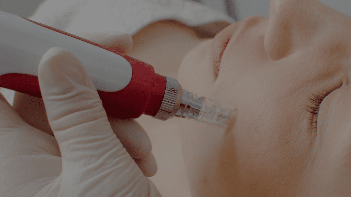 Dermapen facial: Tu aliado para una piel radiante