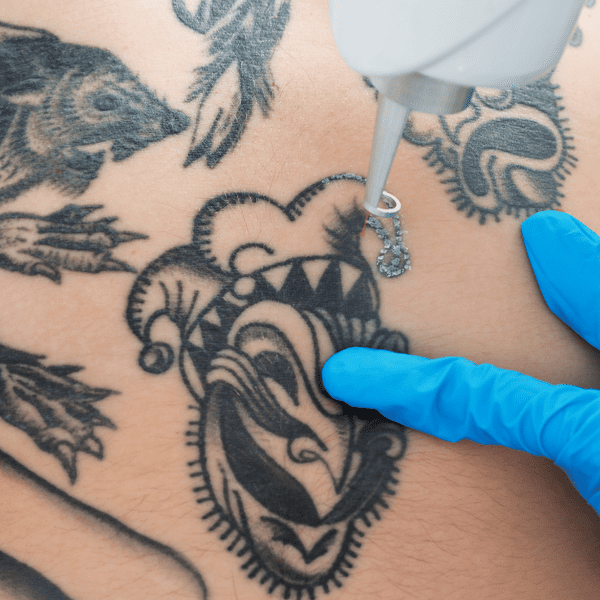 Eliminación de tatuajes: Todo lo que necesitas saber antes de empezar