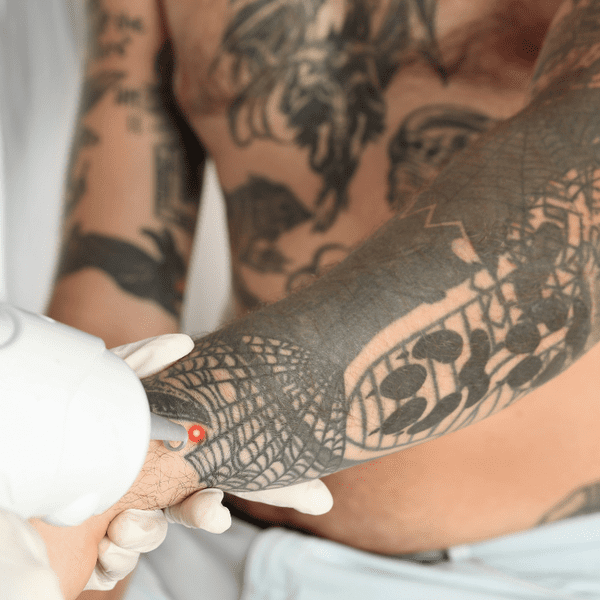 Remoción de Tatuajes: Tecnología Avanzada para Eliminar Tatuajes