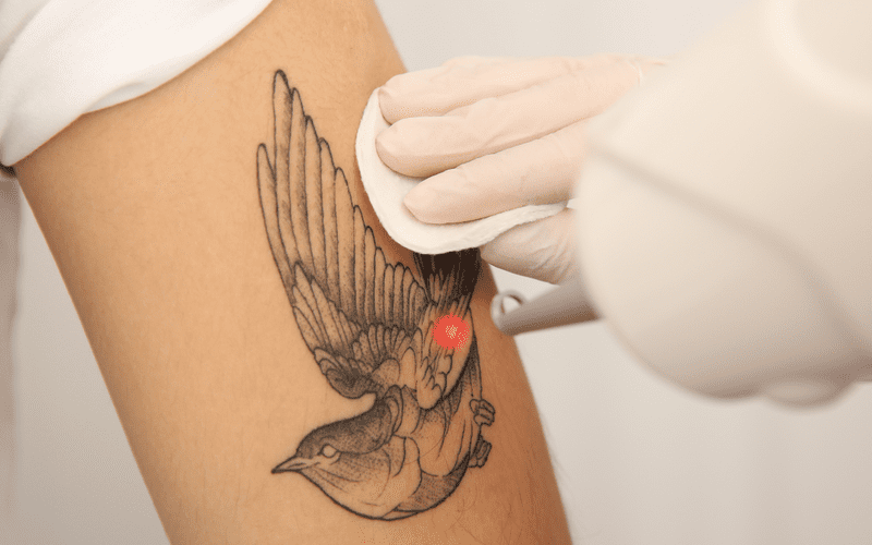 Remoción de Tatuajes y Micropigmentación