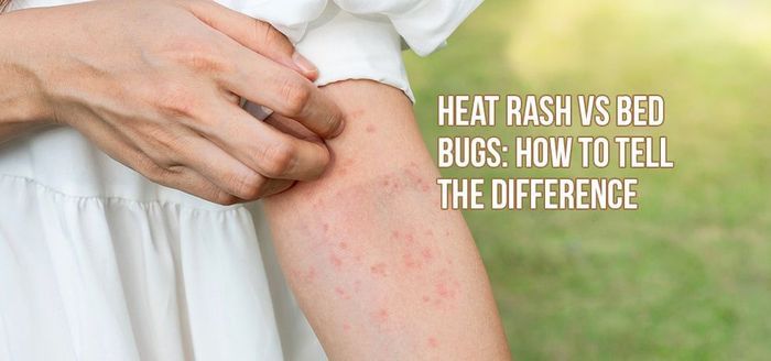 
                    Heat Rash vs. Bed Bugs: How to Tell the Difference
                          