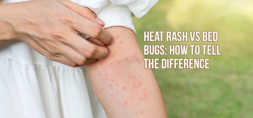 
                Heat Rash vs. Bed Bugs: How to Tell the Difference
                      
