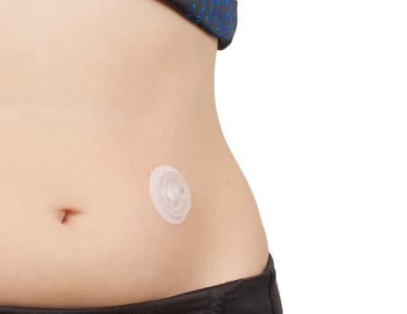 iPort Advance, Injektionsport, 6 mm