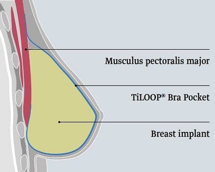 Pfm, TiLOOP Bra Pocket, < 5,5 cm, < 420 ml, steril, small