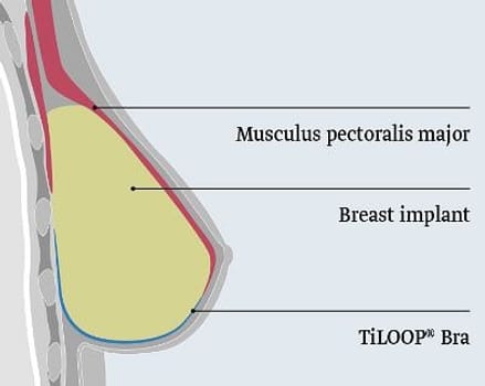 Pfm, TiLOOP Bra, 16 g/m2, steril, medium