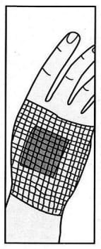 Nobanetz, elastisk netfiksering, hånd nr. 1