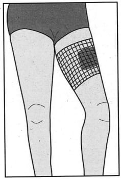 Nobanetz, elastisk netfiksering, lår nr. 5,5