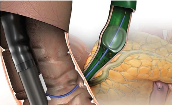 Sten ext ballon shortwire, Inj. above, cath Ø7 Fr. L 200cm, 15/18/20