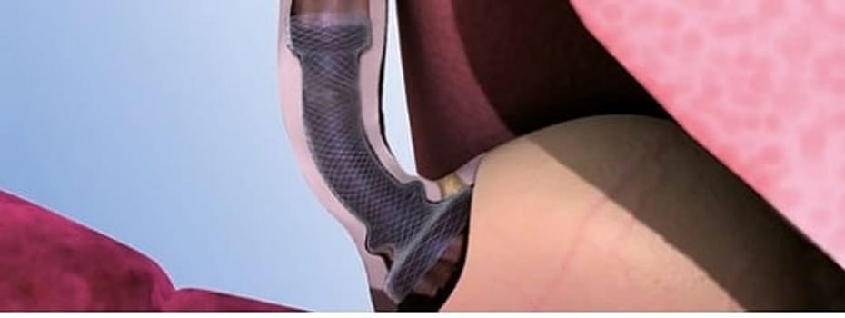 Micro-Tech, Cardi-Umbrella stent, part.covered, st., Ø 24 mm L: 120 mm