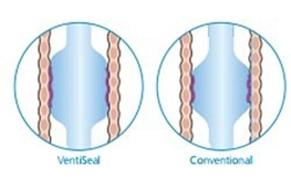 Flexicare Ventiseal tube, endotracheal oral/nasal, murphy eye, cuff st., str. 6,5