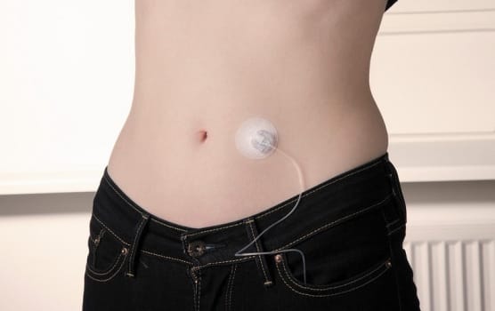 Neria Soft 90, infusionssæt, 27G x 9 mm kateter, steril, 110 cm