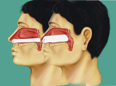 Raucocel Epistaxis, 100, næsetamponade, med snor, steril, 100 mm