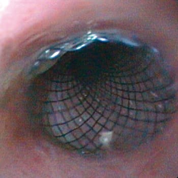 Micro-Tech, Cardia-valve stent, part covered, Ø 20/26mm L: 100 mm