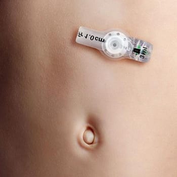 Freka Belly Button, gastrostomiknapsonde, 1,0 cm, steril, FR 14