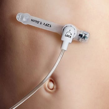 Freka Belly Button, gastrostomiknapsonde, 3,0 cm, steril, FR 24