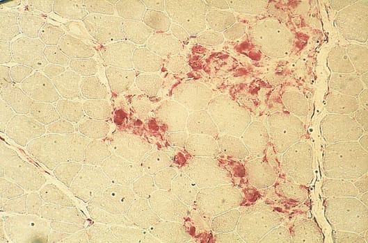 Acid phosphatase -histoentsymaattinen kitti