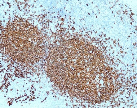 CD20 (QR094) Rb 0,5 ml konsentraatti