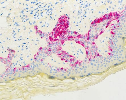 Melanoma (HMB-45) Ms 1,0 ml konsentraatti