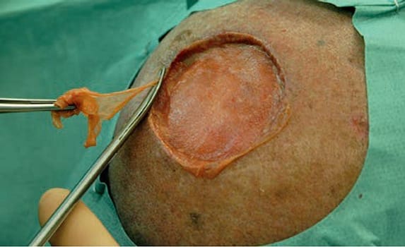 MatriDerm biologinen ihon korvike A9 37x52x1mm