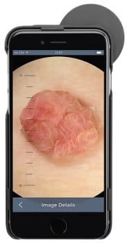 HEINE iC1 digitaalinen dermatoskooppisetti 12 pro