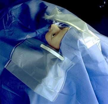 Steri-Drape, hulstykke med klæb, hul 6,3cm, steril, 40 cm x 40 cm