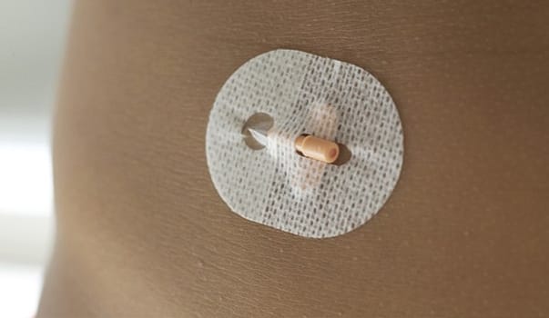 Kanyle infusjon Insuflon G25 18mm