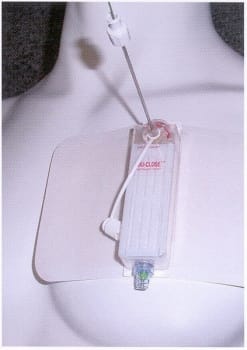 Thoraxdränage Thoracic vent 13fr steril för luftdränage