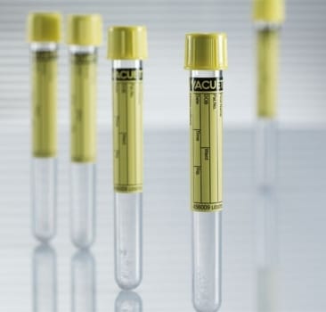 Vakuumrör vacuette borsyra urin 5/4ml gul dragkork papper