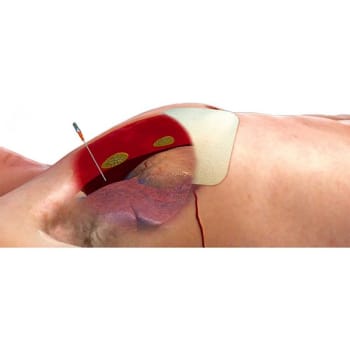 Decompression needle set Tpak 14g