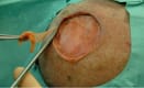 MatriDerm biologinen ihon korvike A9 37x52x1mm