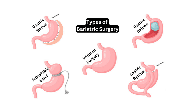 Types of Bariatric Surgery